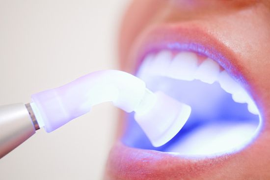 Фото - Лазерное отбеливание зубов —  это быстрый способ сделать зубы белоснежными