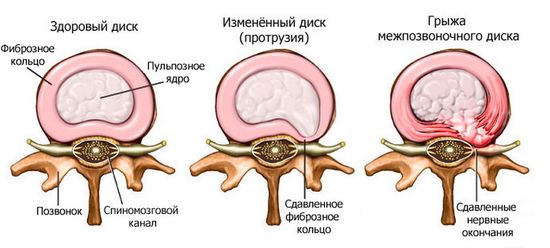 Грыжа позвоночника