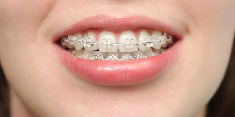 Фото на тему: Как выровнять зубы в домашних условиях взрослому?