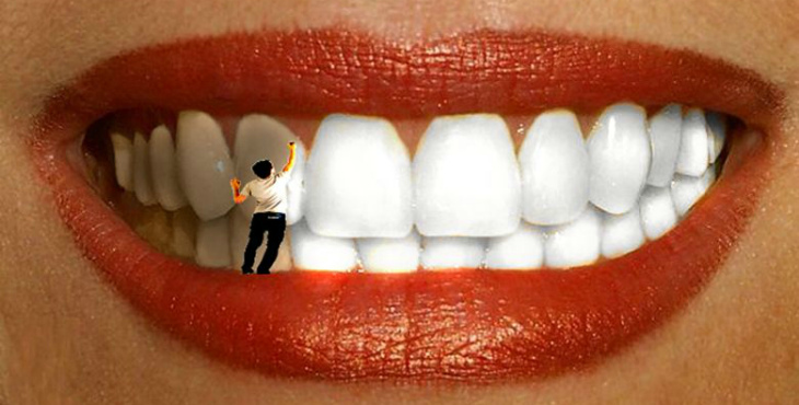 Фото на тему: Отбеливание зубов – нужно ли готовиться?