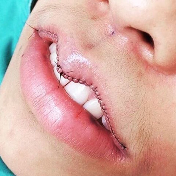 Фото на тему: Новый тренд: ушивают губы, чтобы изменить форму рта!